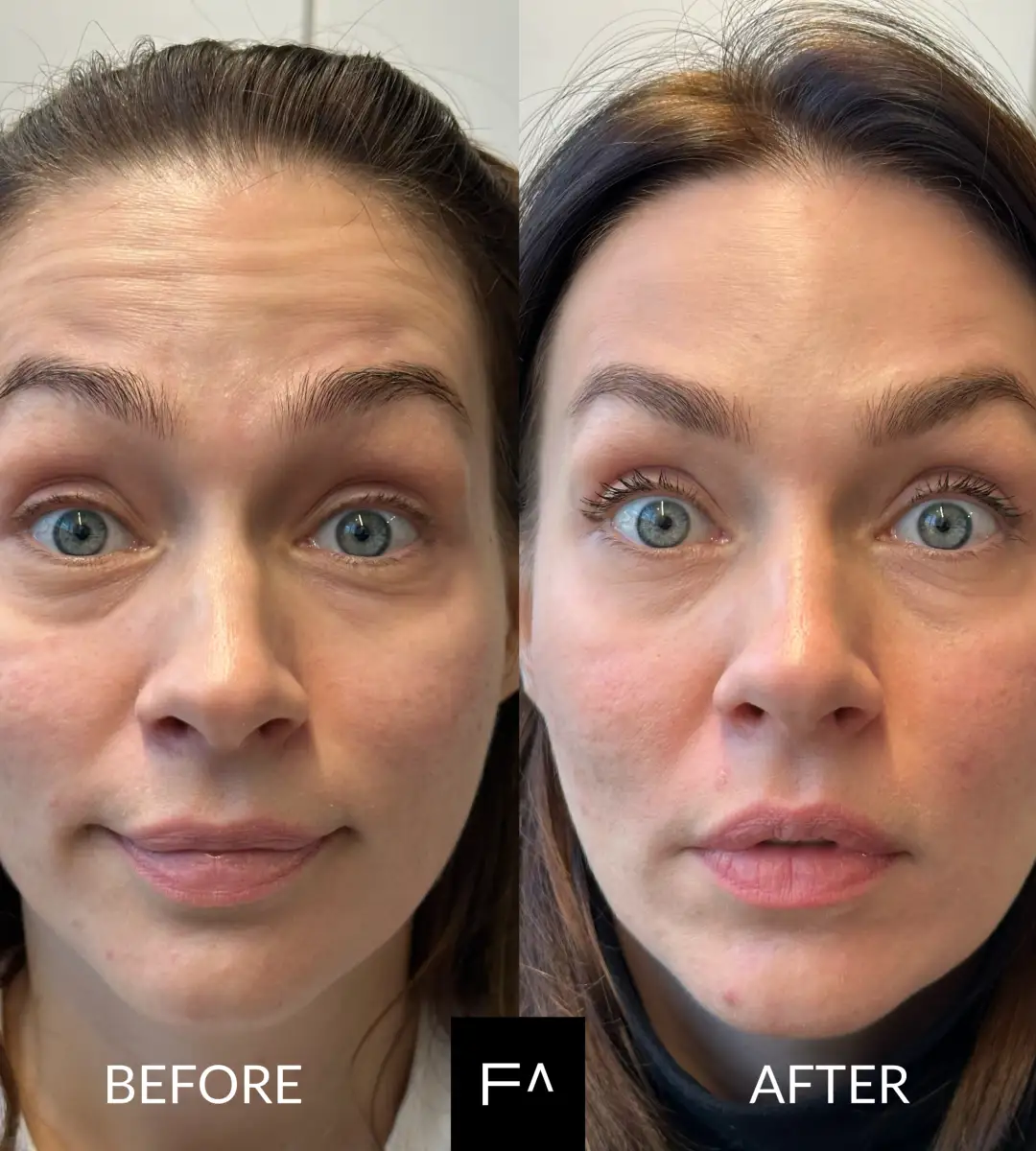 Τι απαγορεύεται μετά το Botox;