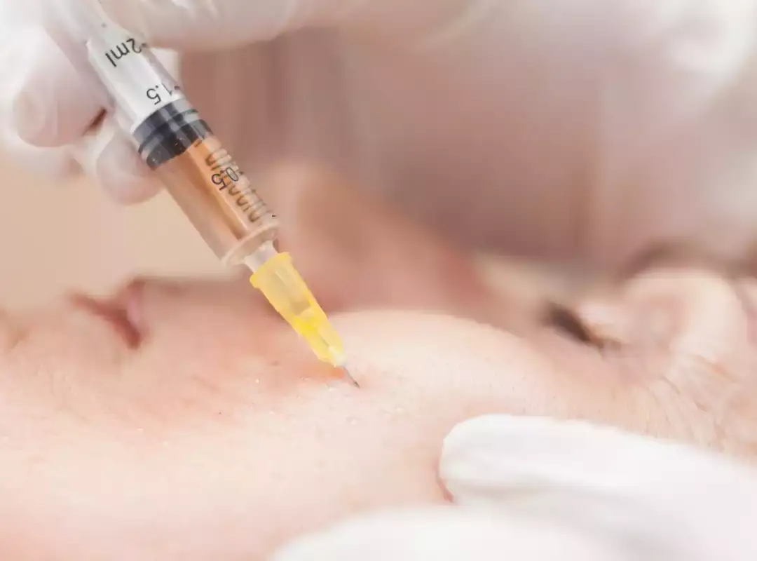 PRP Facial Treatment
